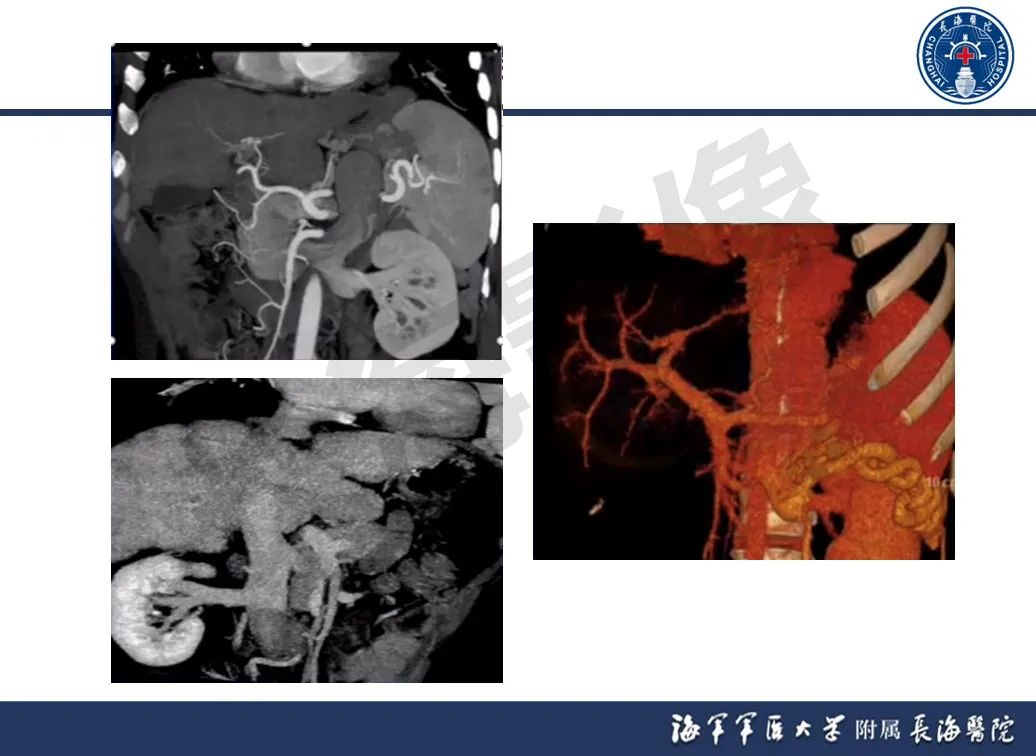 影像PPT - 【PPT】肝窦阻塞综合征的影像学诊断-50