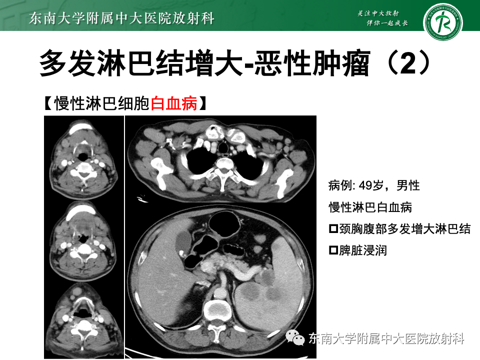 影像PPT - 【PPT】多发性淋巴结增大影像诊断思路-25