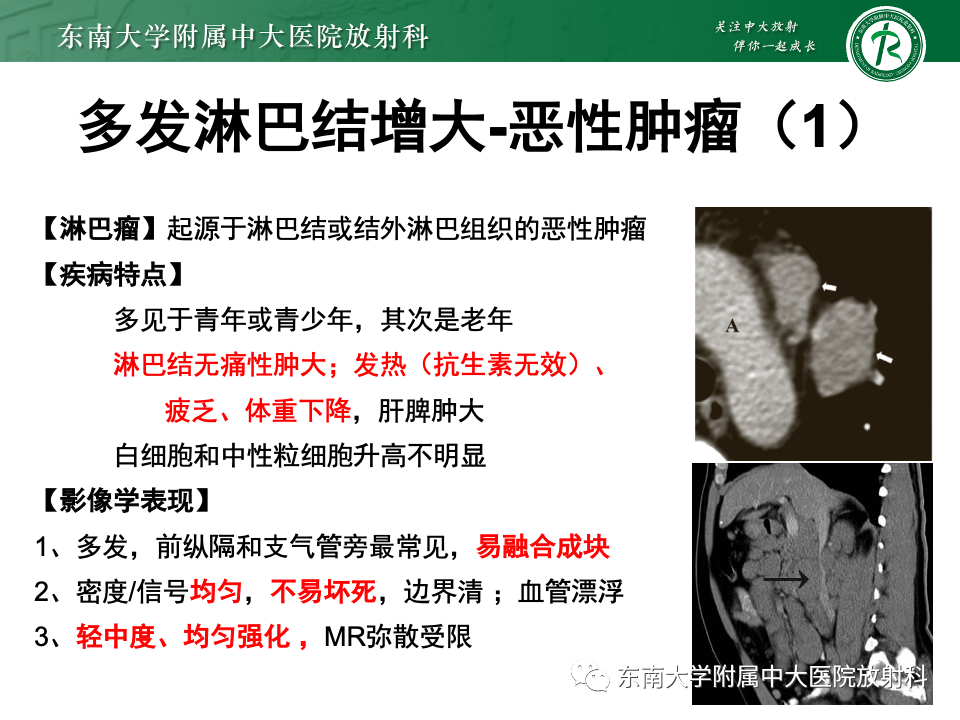 影像PPT - 【PPT】多发性淋巴结增大影像诊断思路-22