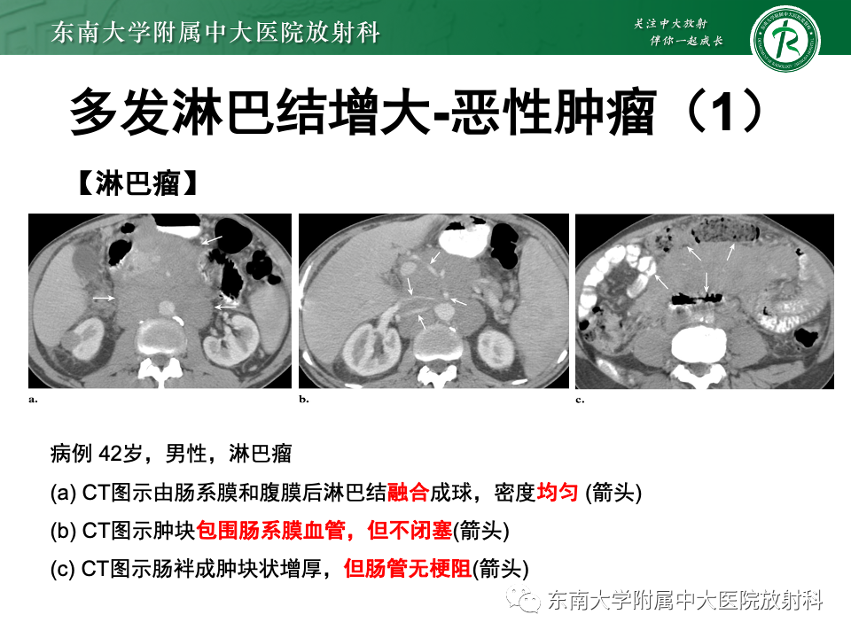 影像PPT - 【PPT】多发性淋巴结增大影像诊断思路-23