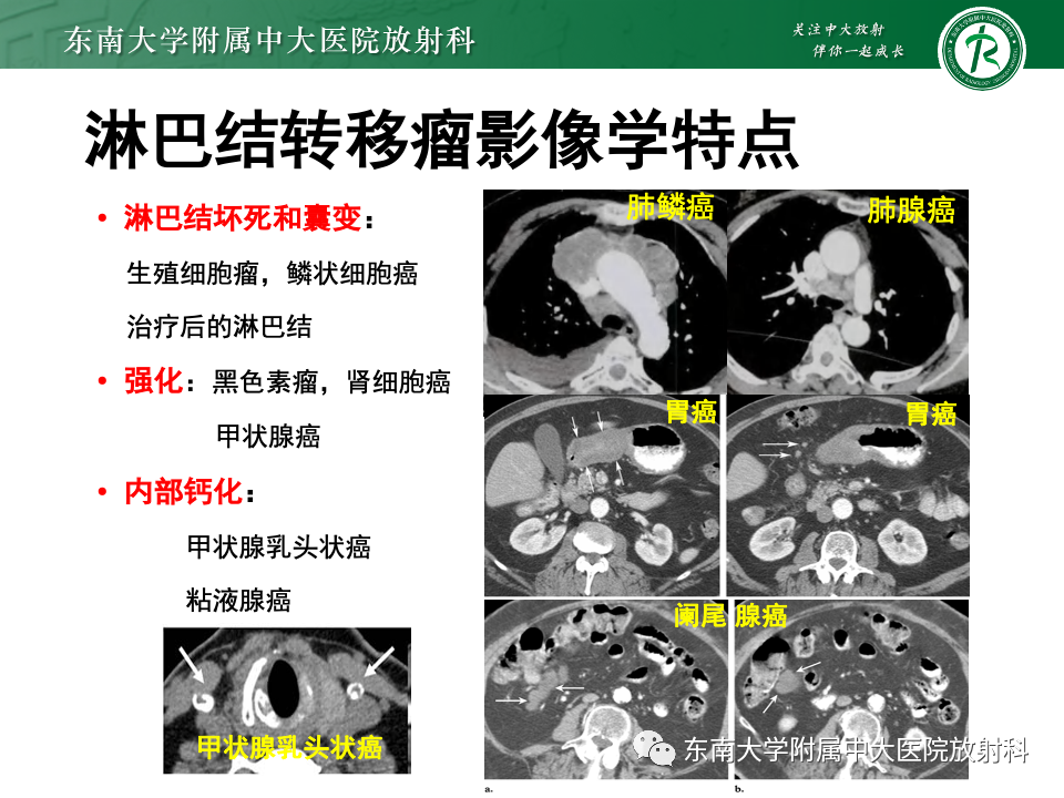 影像PPT - 【PPT】多发性淋巴结增大影像诊断思路-27
