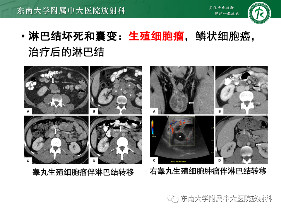 影像PPT - 【PPT】多发性淋巴结增大影像诊断思路-28