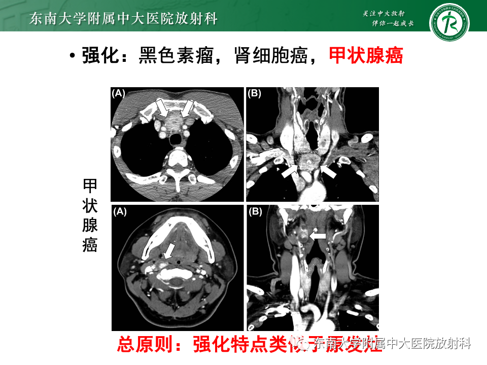 影像PPT - 【PPT】多发性淋巴结增大影像诊断思路-31
