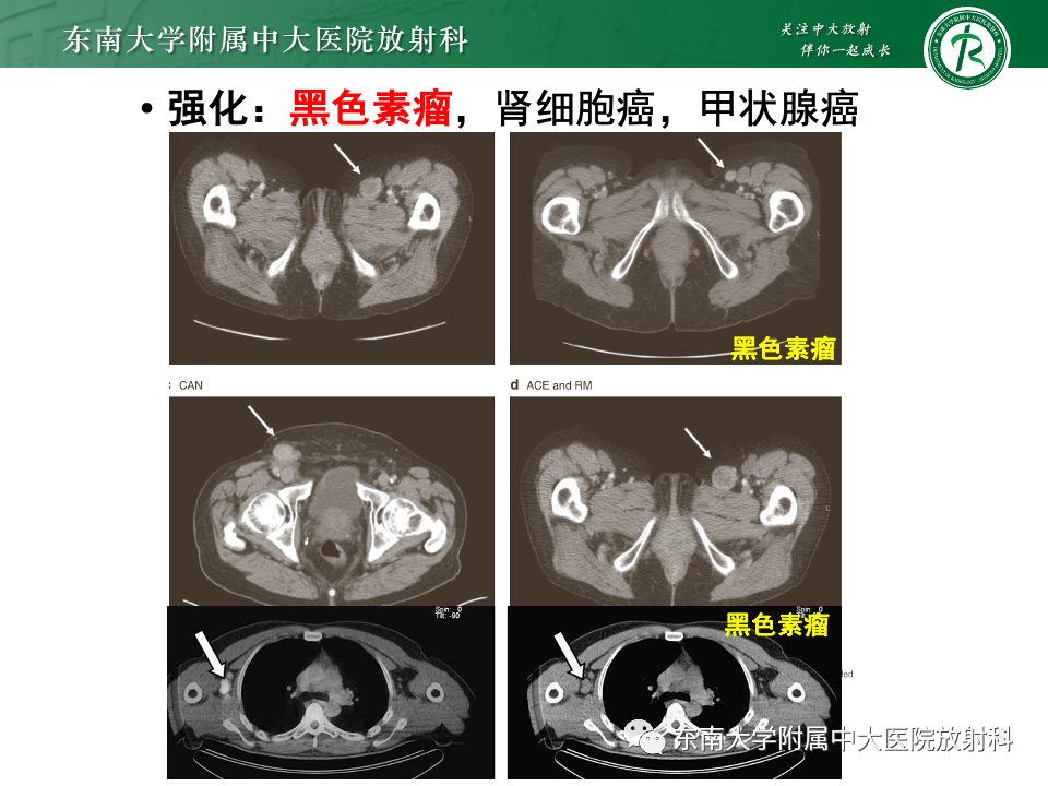 影像PPT - 【PPT】多发性淋巴结增大影像诊断思路-29