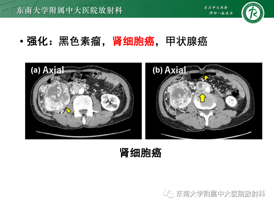 影像PPT - 【PPT】多发性淋巴结增大影像诊断思路-30