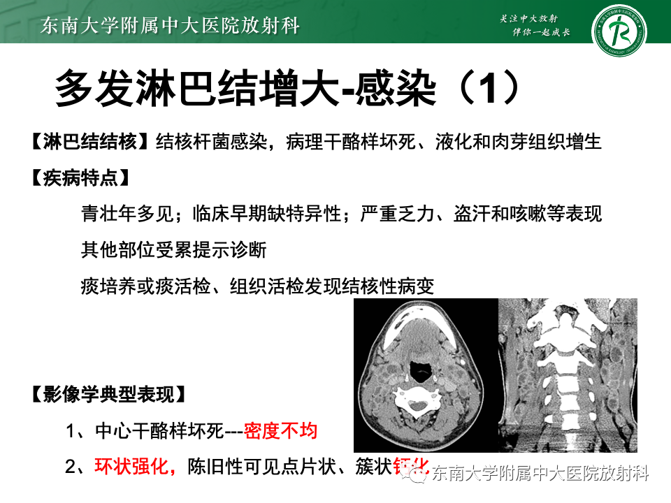 影像PPT - 【PPT】多发性淋巴结增大影像诊断思路-32