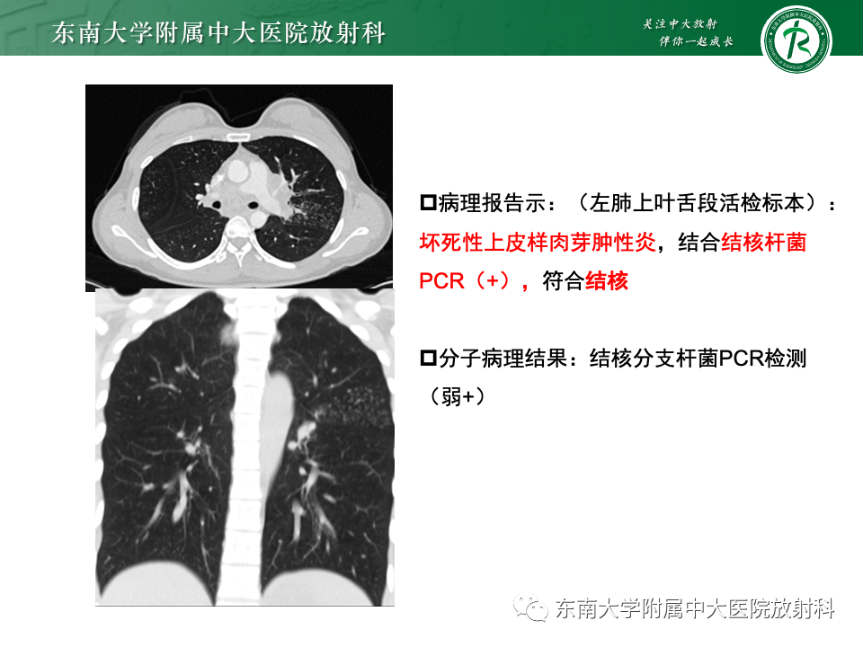 影像PPT - 【PPT】多发性淋巴结增大影像诊断思路-34