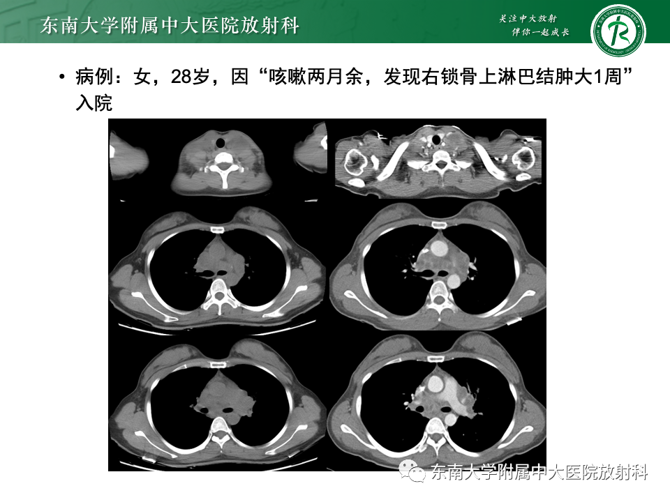 影像PPT - 【PPT】多发性淋巴结增大影像诊断思路-33