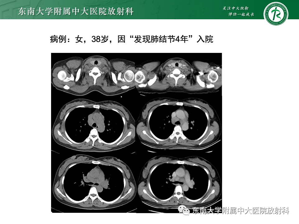 影像PPT - 【PPT】多发性淋巴结增大影像诊断思路-38