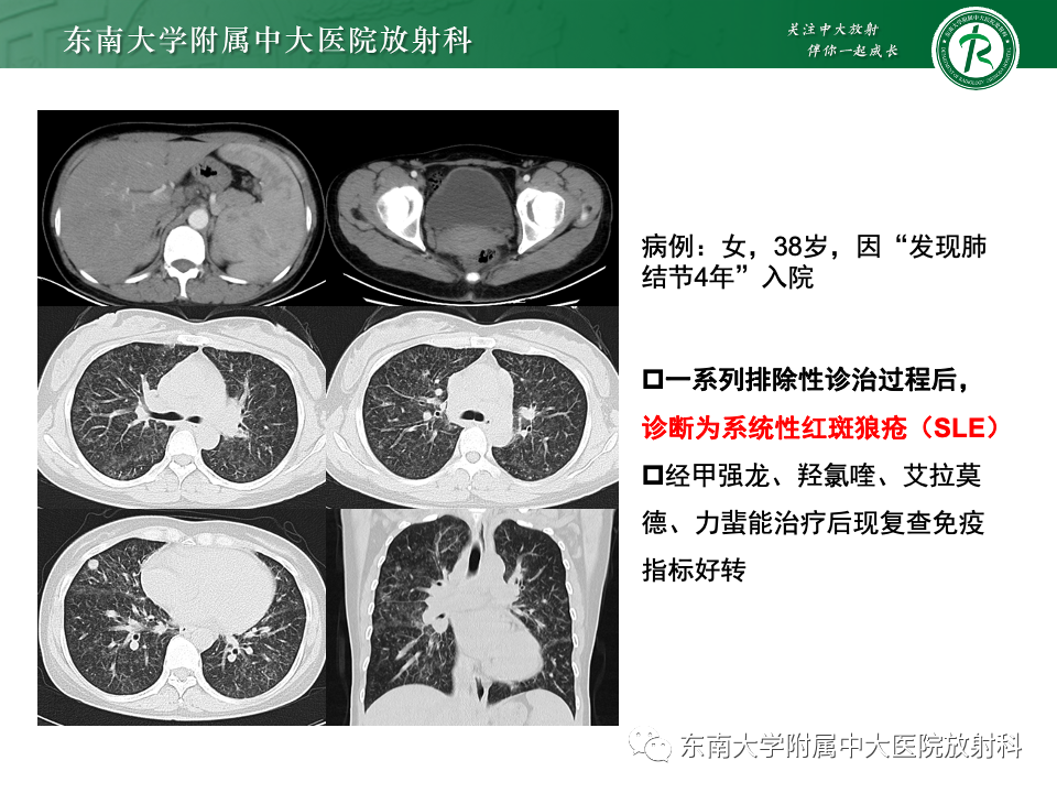 影像PPT - 【PPT】多发性淋巴结增大影像诊断思路-39