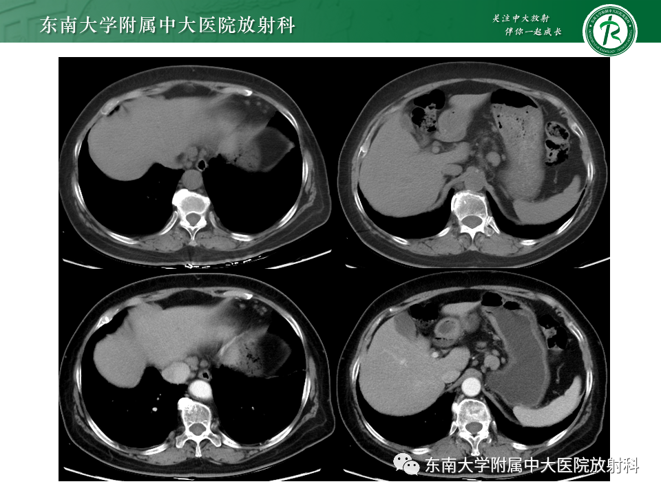 影像PPT - 【PPT】多发性淋巴结增大影像诊断思路-42