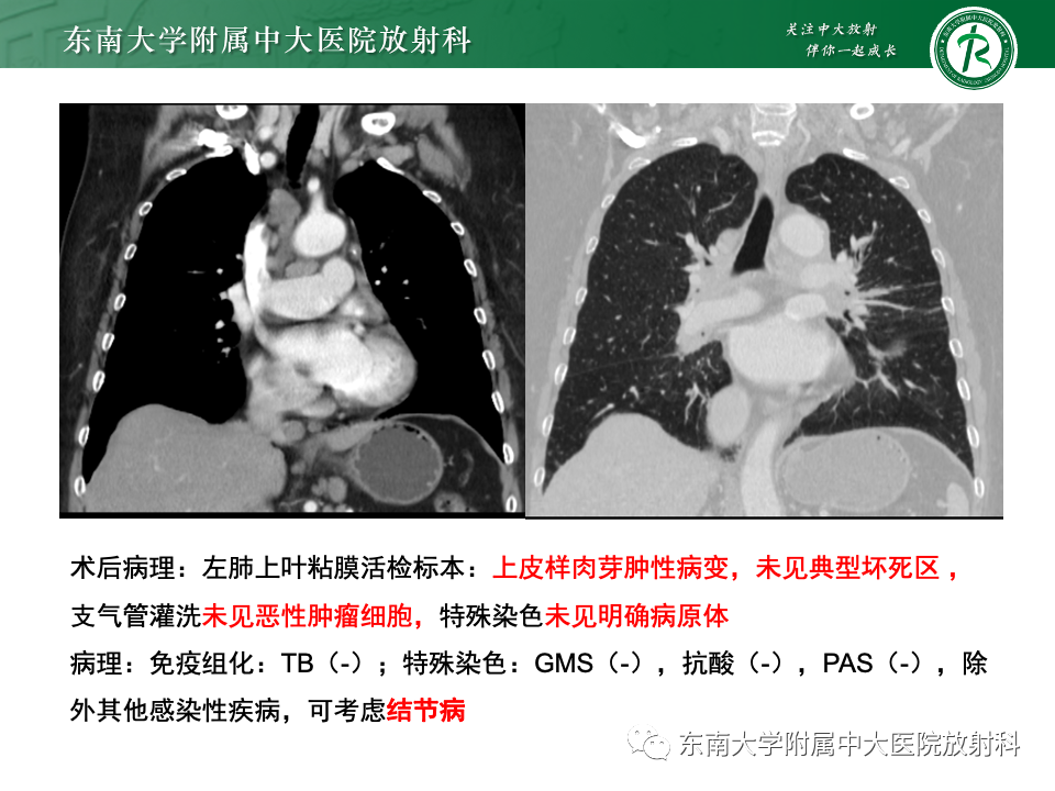 影像PPT - 【PPT】多发性淋巴结增大影像诊断思路-43
