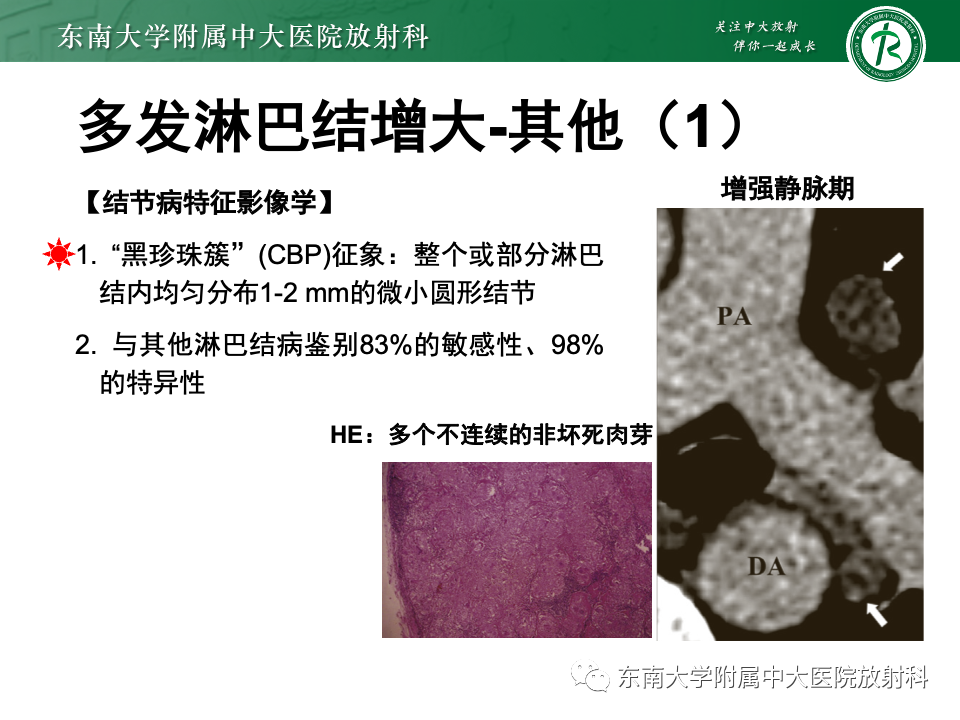 影像PPT - 【PPT】多发性淋巴结增大影像诊断思路-44
