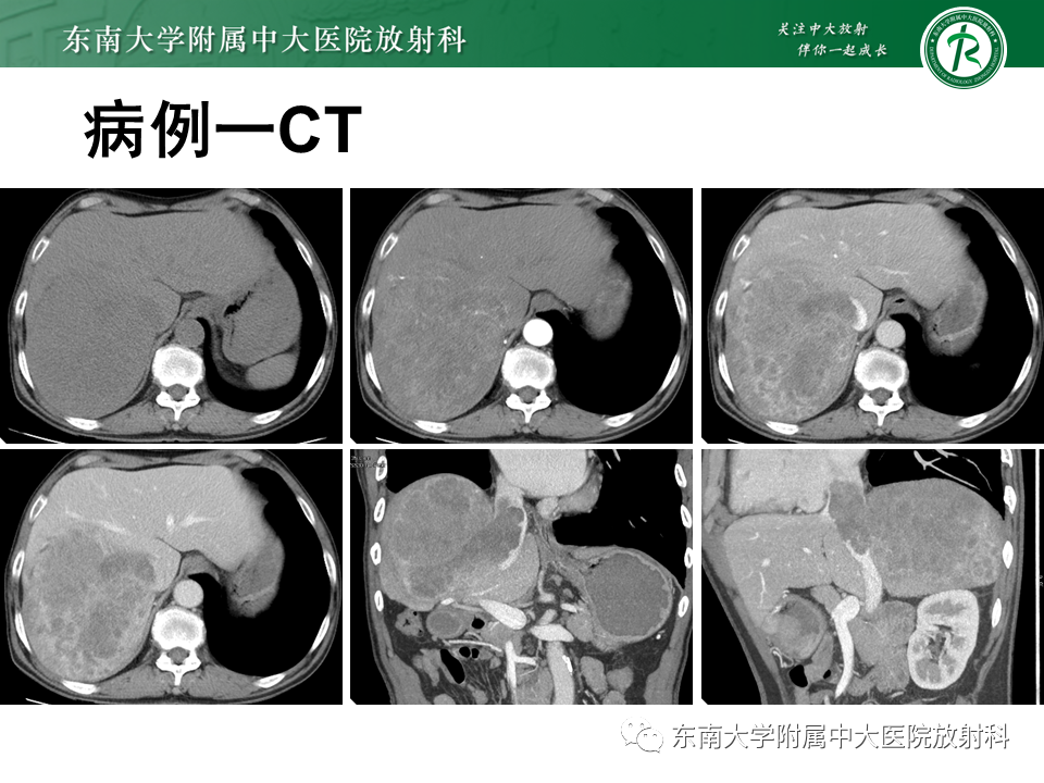 影像PPT - 【PPT】肝脏占位 易误诊病例随访-6
