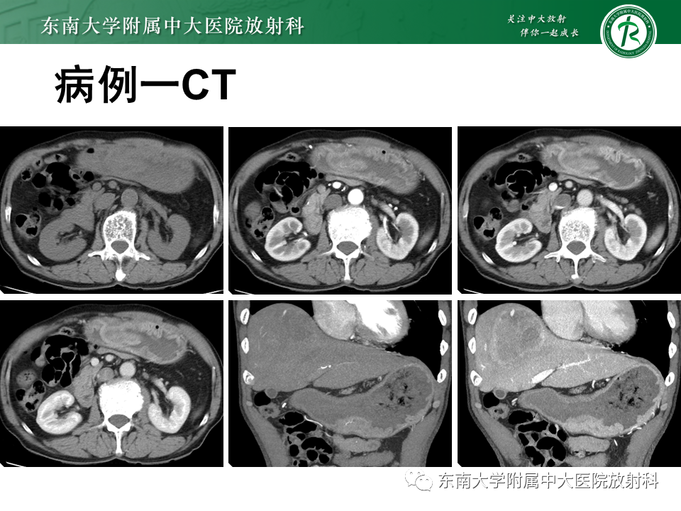 影像PPT - 【PPT】肝脏占位 易误诊病例随访-7