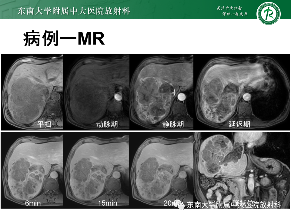 影像PPT - 【PPT】肝脏占位 易误诊病例随访-9