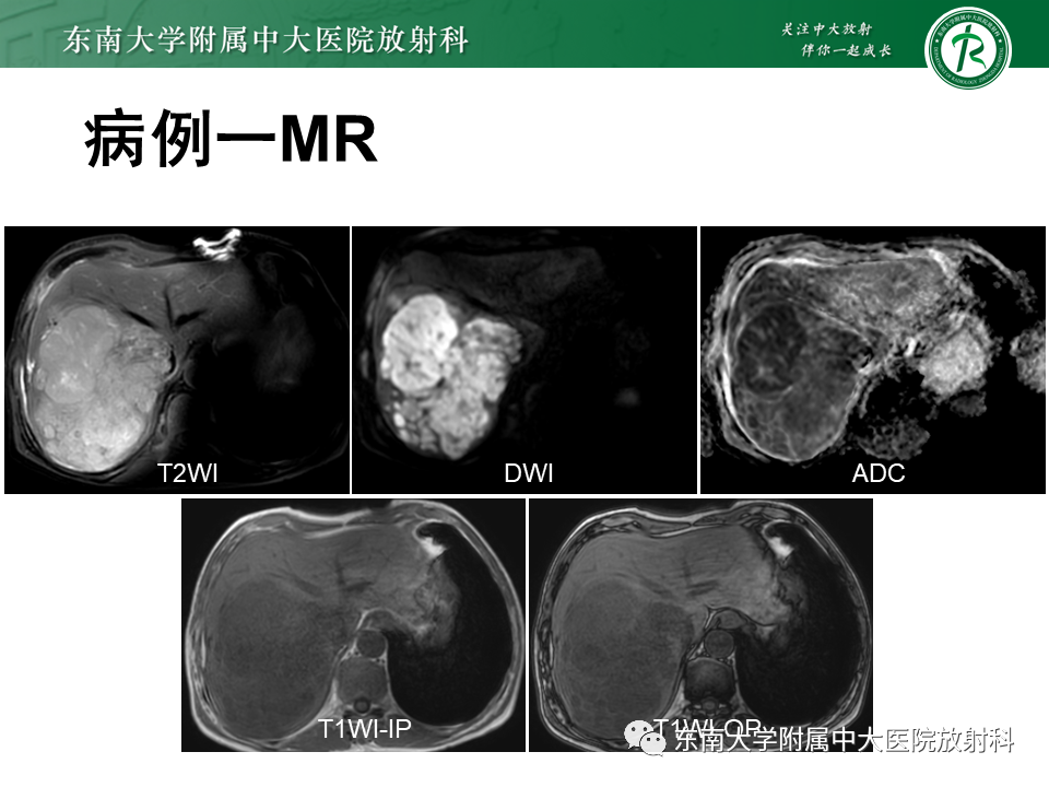 影像PPT - 【PPT】肝脏占位 易误诊病例随访-8