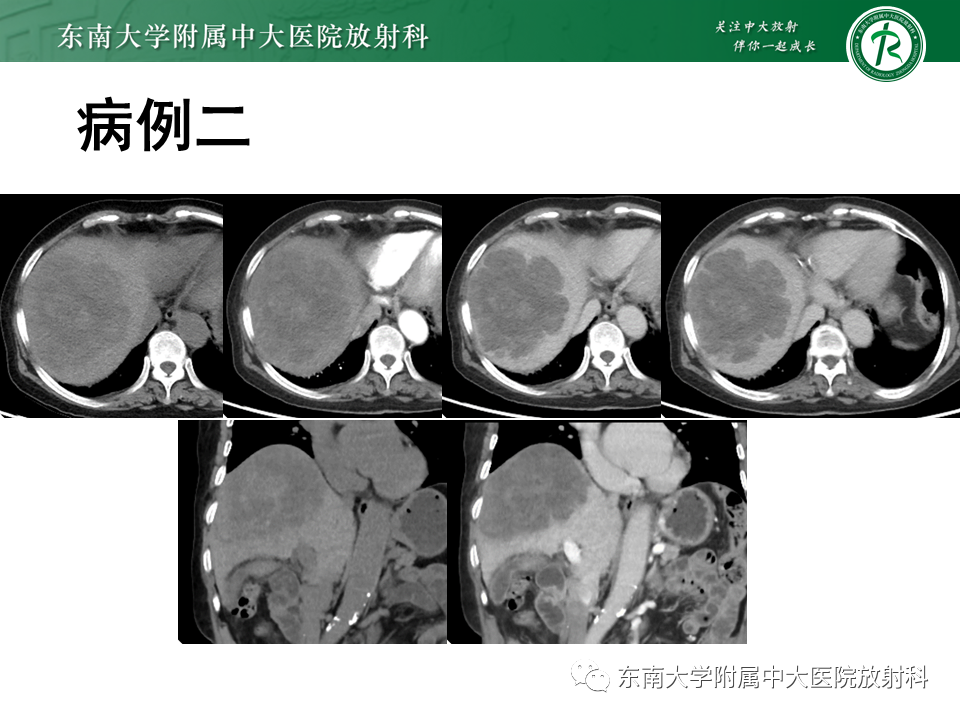 影像PPT - 【PPT】肝脏占位 易误诊病例随访-12