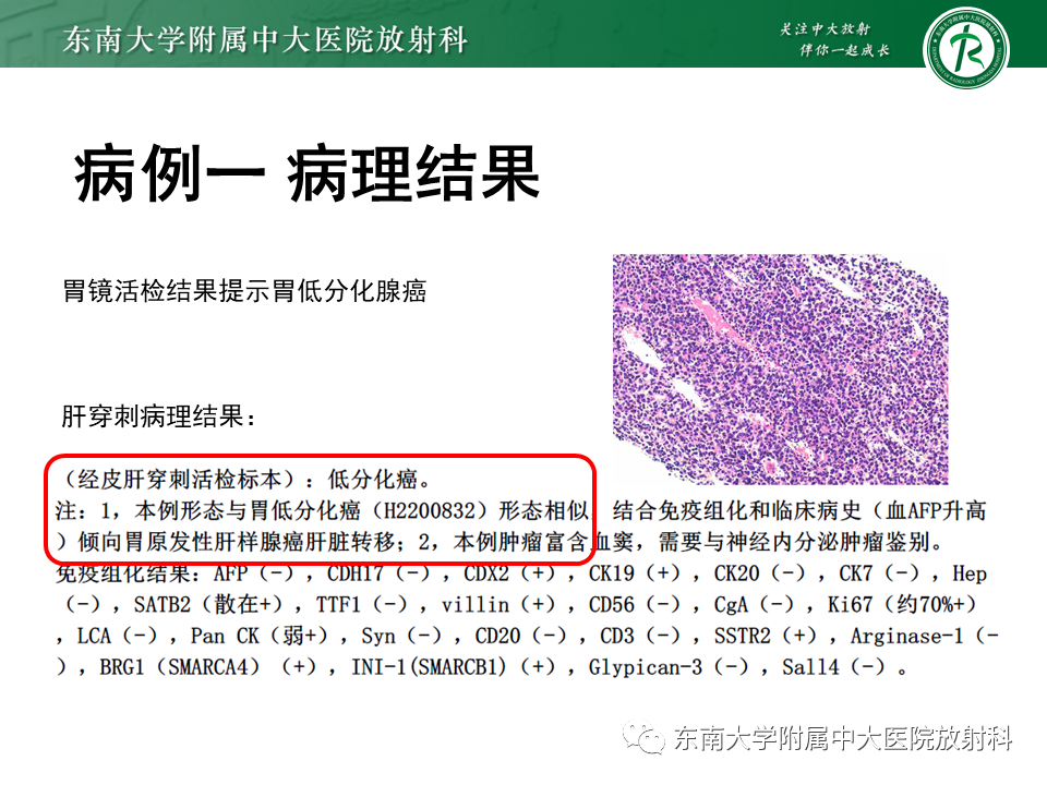 影像PPT - 【PPT】肝脏占位 易误诊病例随访-10