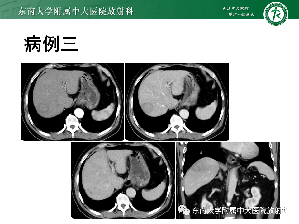 影像PPT - 【PPT】肝脏占位 易误诊病例随访-15