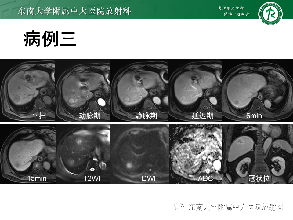 影像PPT - 【PPT】肝脏占位 易误诊病例随访-16