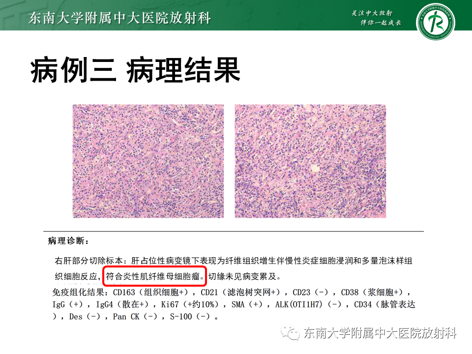影像PPT - 【PPT】肝脏占位 易误诊病例随访-17