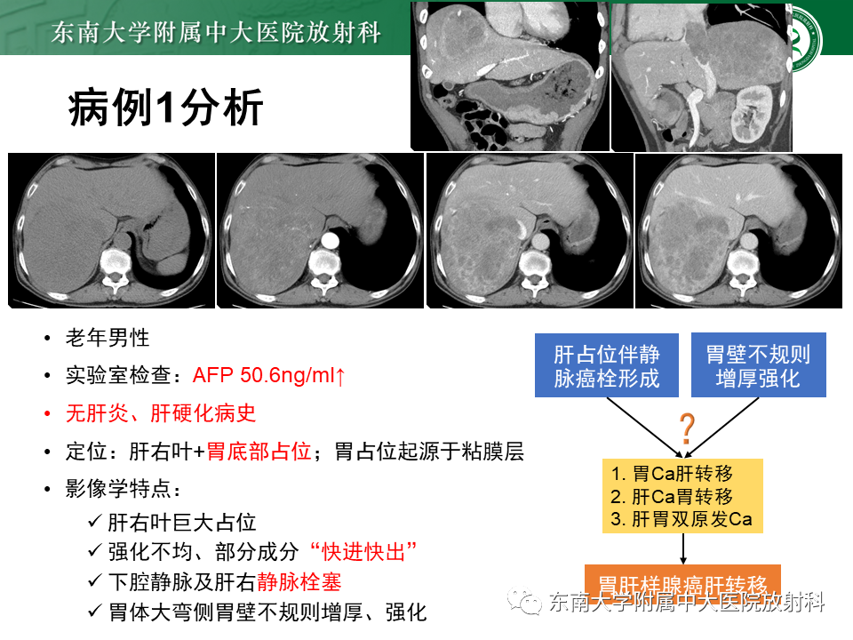 影像PPT - 【PPT】肝脏占位 易误诊病例随访-22