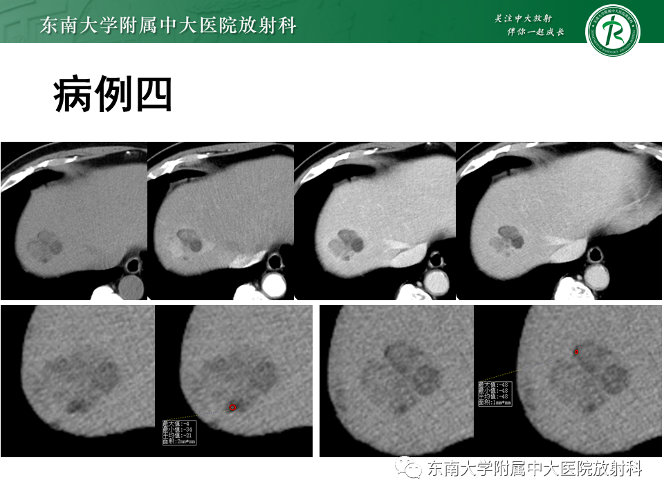 影像PPT - 【PPT】肝脏占位 易误诊病例随访-19