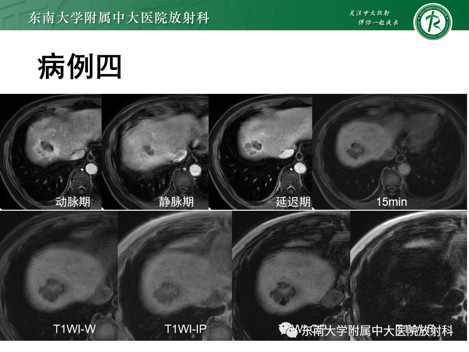 影像PPT - 【PPT】肝脏占位 易误诊病例随访-20