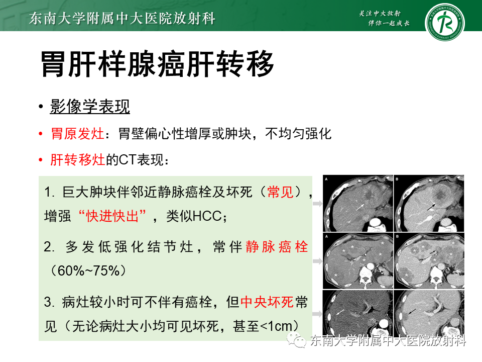 影像PPT - 【PPT】肝脏占位 易误诊病例随访-26