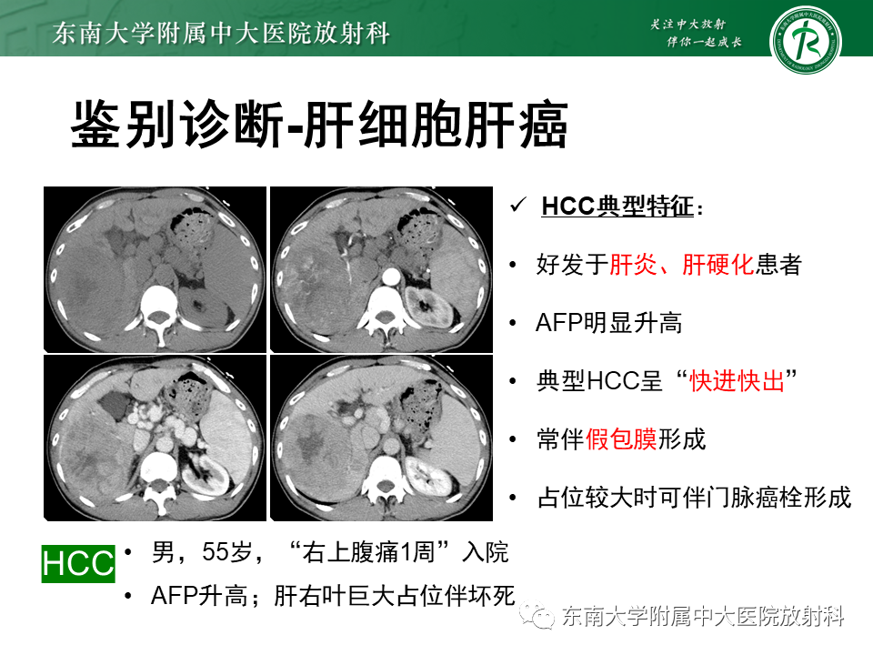 影像PPT - 【PPT】肝脏占位 易误诊病例随访-29