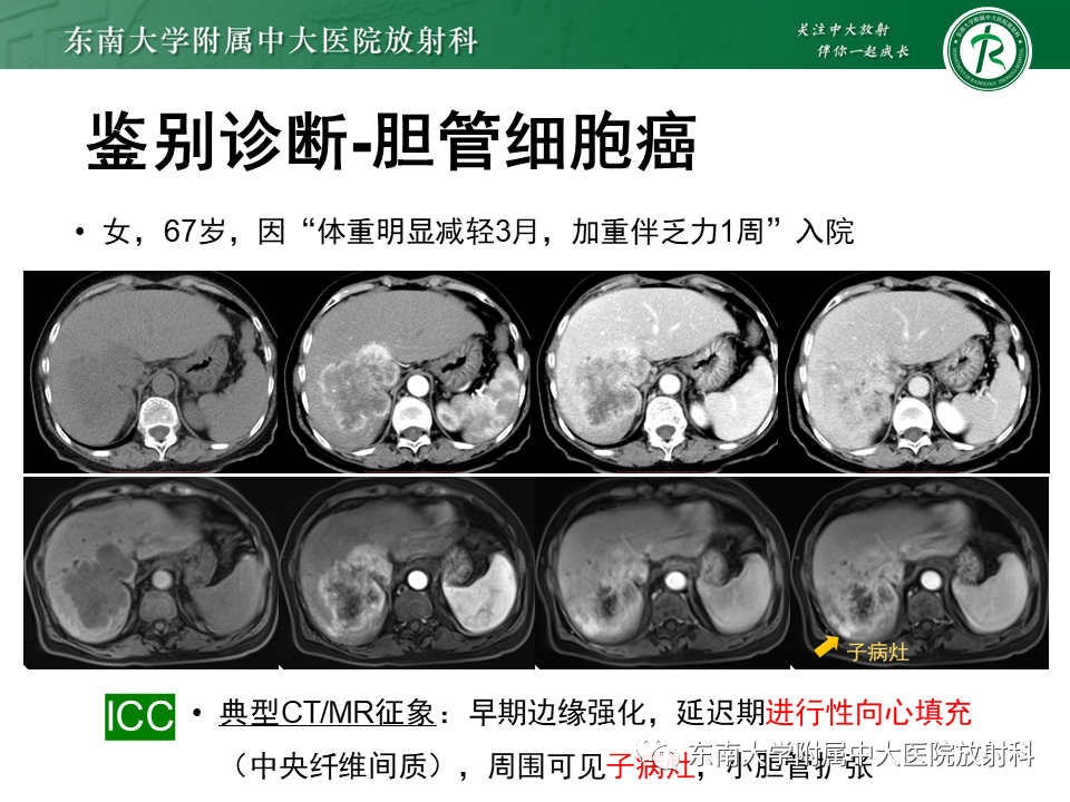 影像PPT - 【PPT】肝脏占位 易误诊病例随访-30