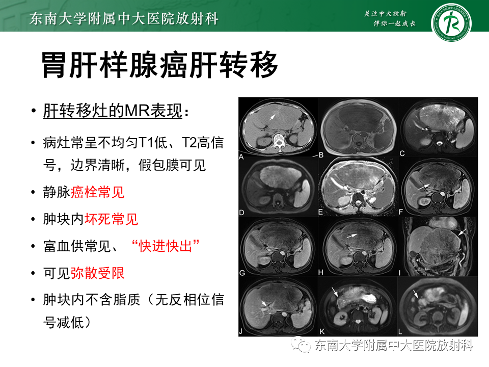 影像PPT - 【PPT】肝脏占位 易误诊病例随访-27