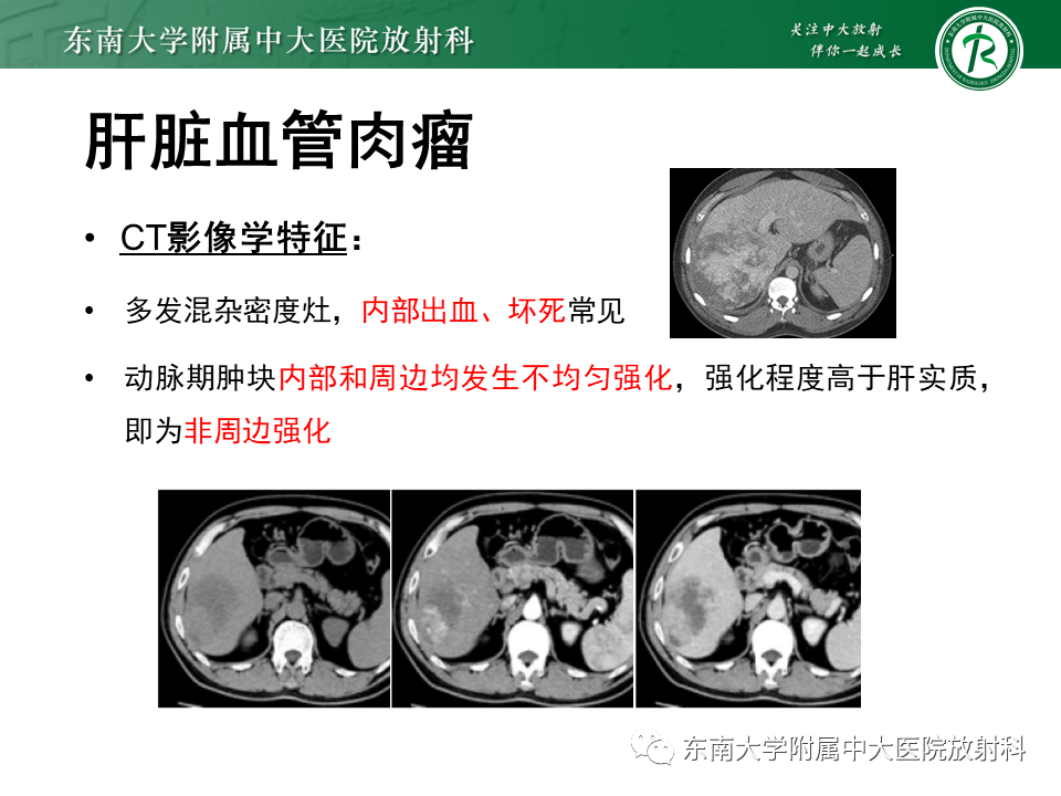 影像PPT - 【PPT】肝脏占位 易误诊病例随访-35