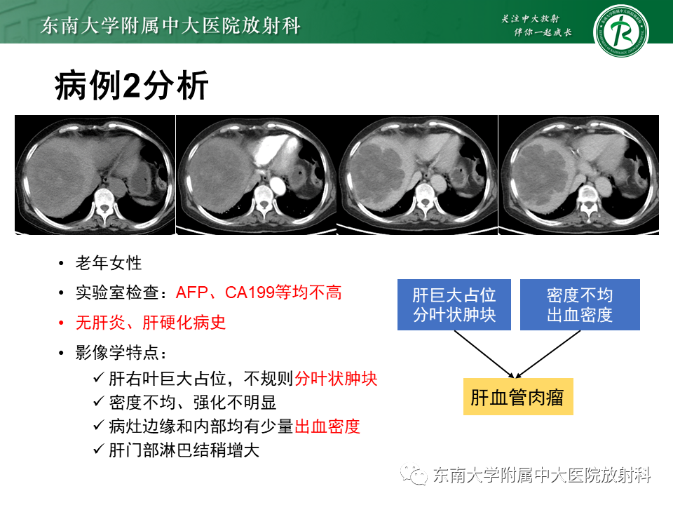 影像PPT - 【PPT】肝脏占位 易误诊病例随访-33
