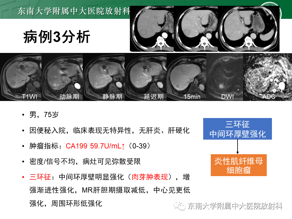 影像PPT - 【PPT】肝脏占位 易误诊病例随访-38