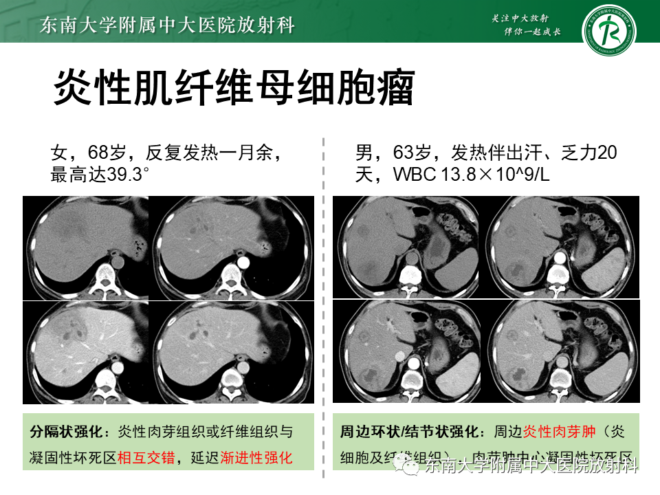 影像PPT - 【PPT】肝脏占位 易误诊病例随访-42