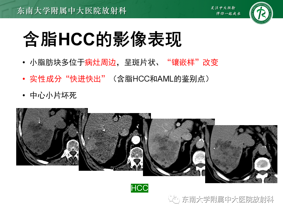 影像PPT - 【PPT】肝脏占位 易误诊病例随访-50