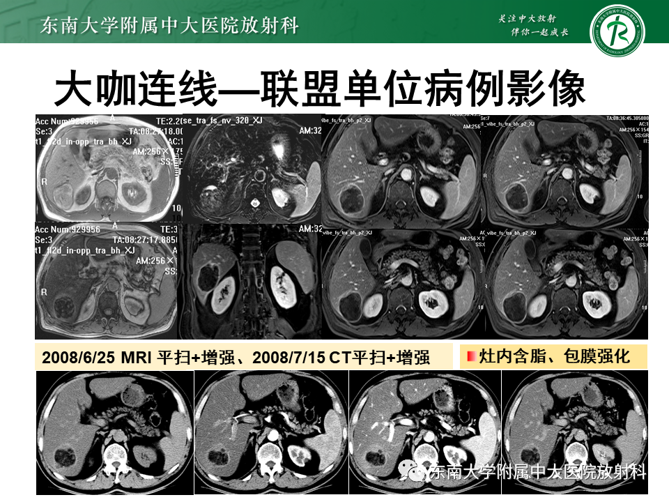 影像PPT - 【PPT】肝脏占位 易误诊病例随访-53