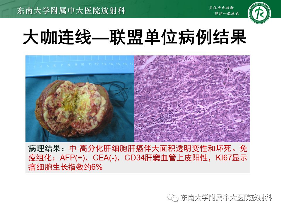 影像PPT - 【PPT】肝脏占位 易误诊病例随访-54