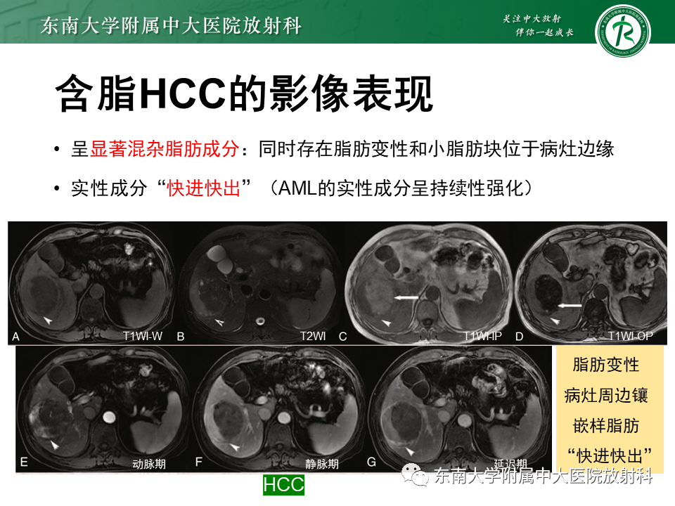 影像PPT - 【PPT】肝脏占位 易误诊病例随访-51