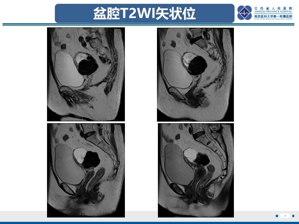 影像PPT - 【PPT】卵巢纤维上皮瘤-4