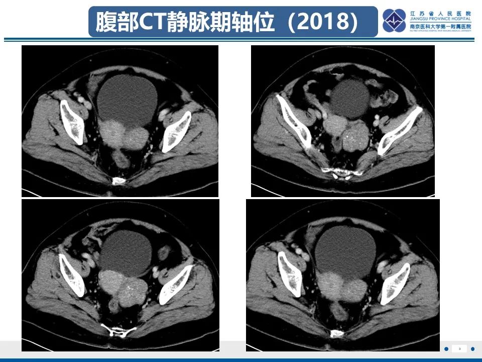 影像PPT - 【PPT】卵巢纤维上皮瘤-3