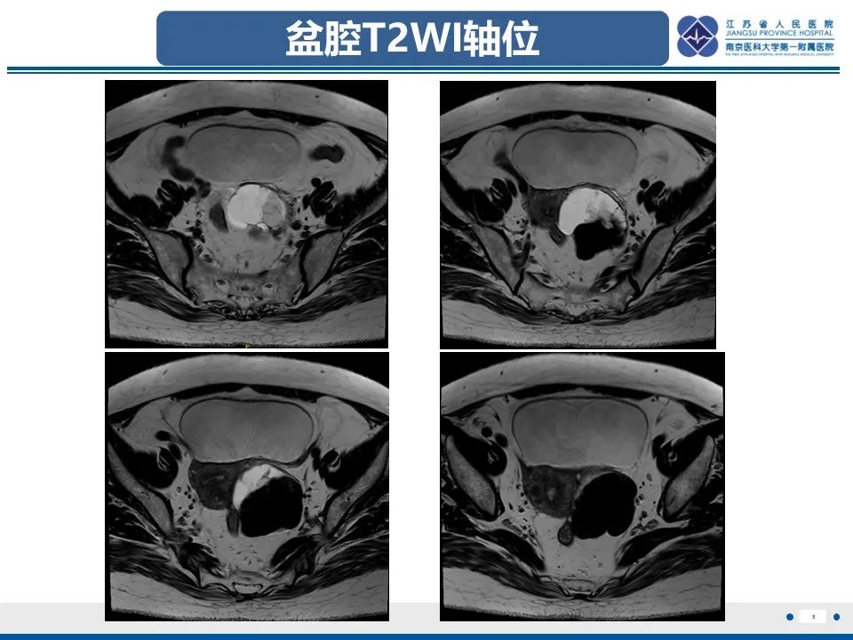 影像PPT - 【PPT】卵巢纤维上皮瘤-5