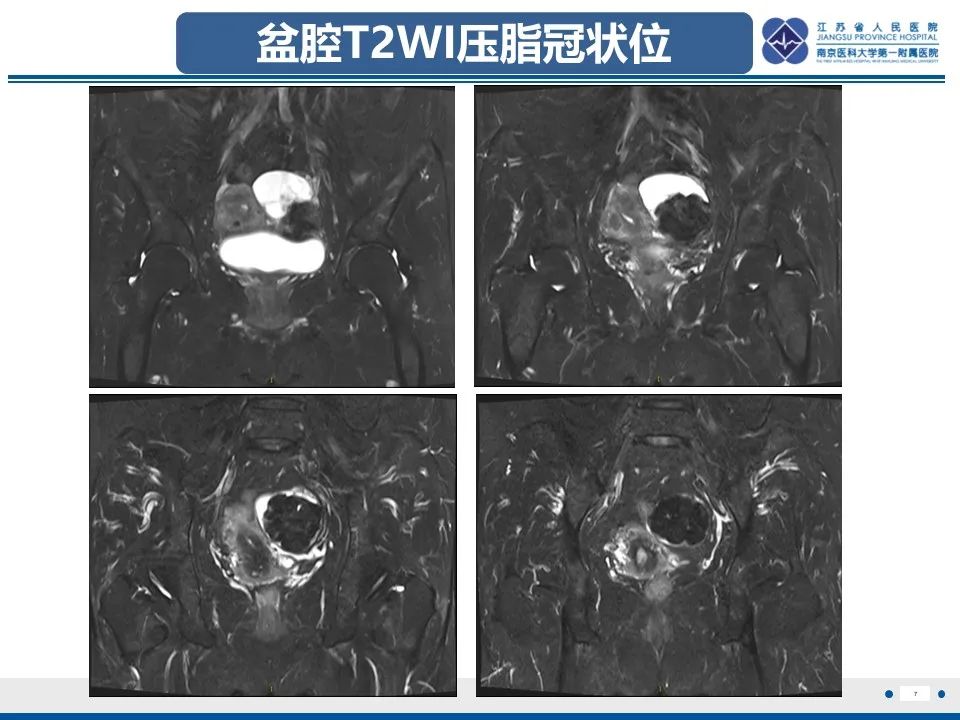 影像PPT - 【PPT】卵巢纤维上皮瘤-7