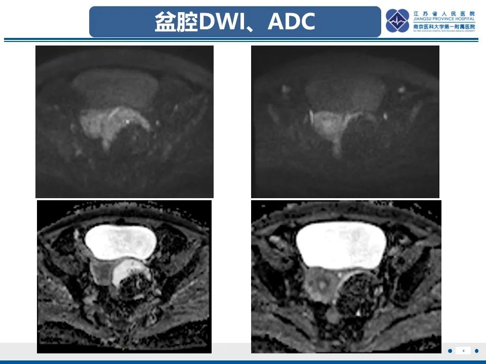 影像PPT - 【PPT】卵巢纤维上皮瘤-8