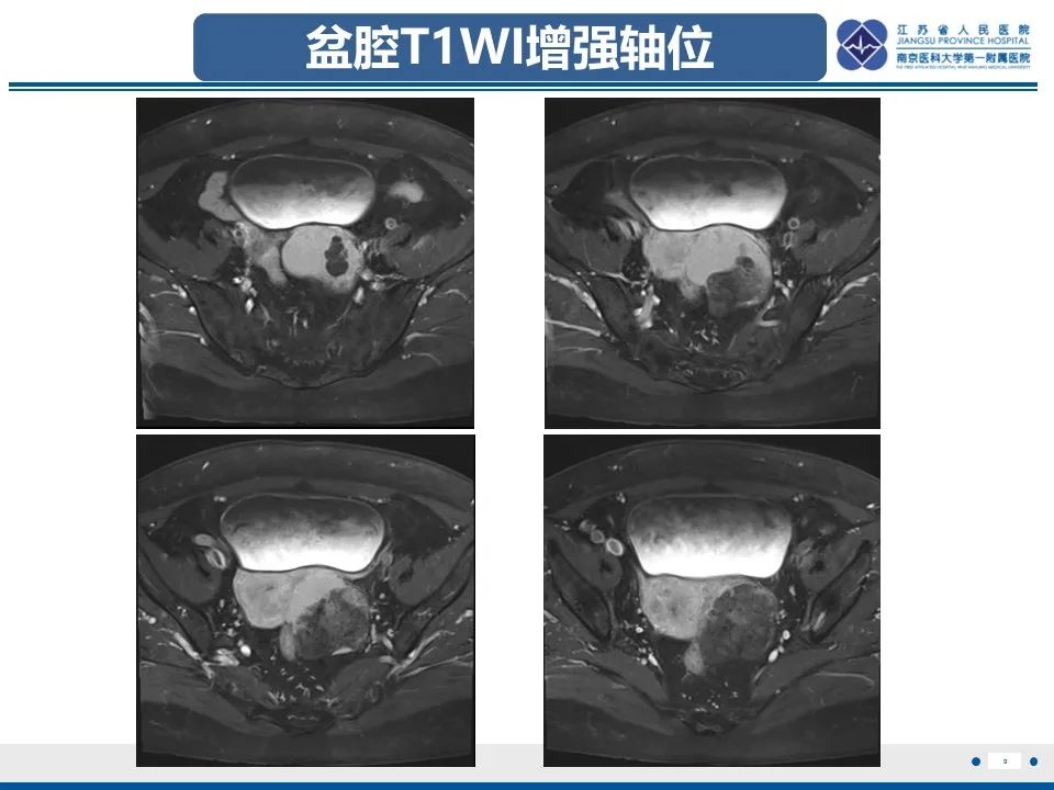 影像PPT - 【PPT】卵巢纤维上皮瘤-9