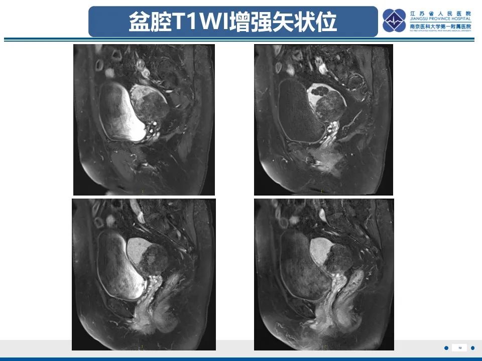 影像PPT - 【PPT】卵巢纤维上皮瘤-10