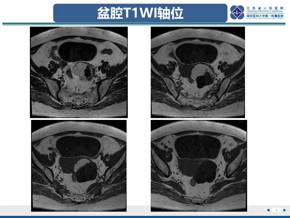 影像PPT - 【PPT】卵巢纤维上皮瘤-6