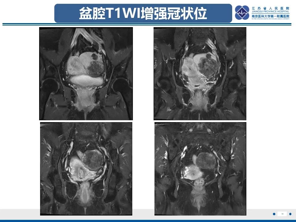 影像PPT - 【PPT】卵巢纤维上皮瘤-11